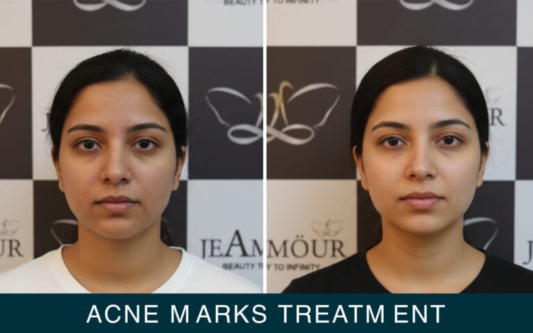 acne marks treatment by jeamour clinic in chandigarh and jalandhar