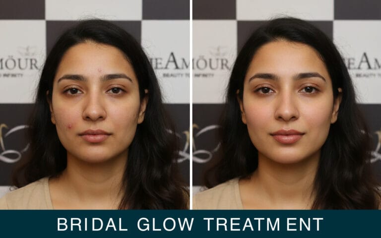 bridal glow treatment by jeamour clinic
