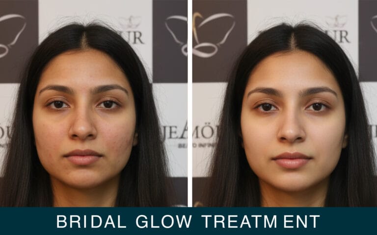 bridal glow treatment by jeamour clinic